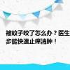 被蚊子咬了怎么办？医生教你三步能快速止痒消肿！