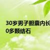 30岁男子胆囊内长满300多颗结石