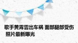 歌手黄霄雲出车祸 面部腿部受伤 照片最新曝光